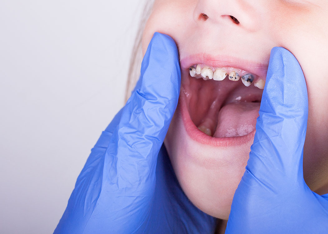 Kalkberg Zahnärzte Bad Segeberg Kinder-Zahnheilkunde Zahnmedizin Milchzahn-Behandlung